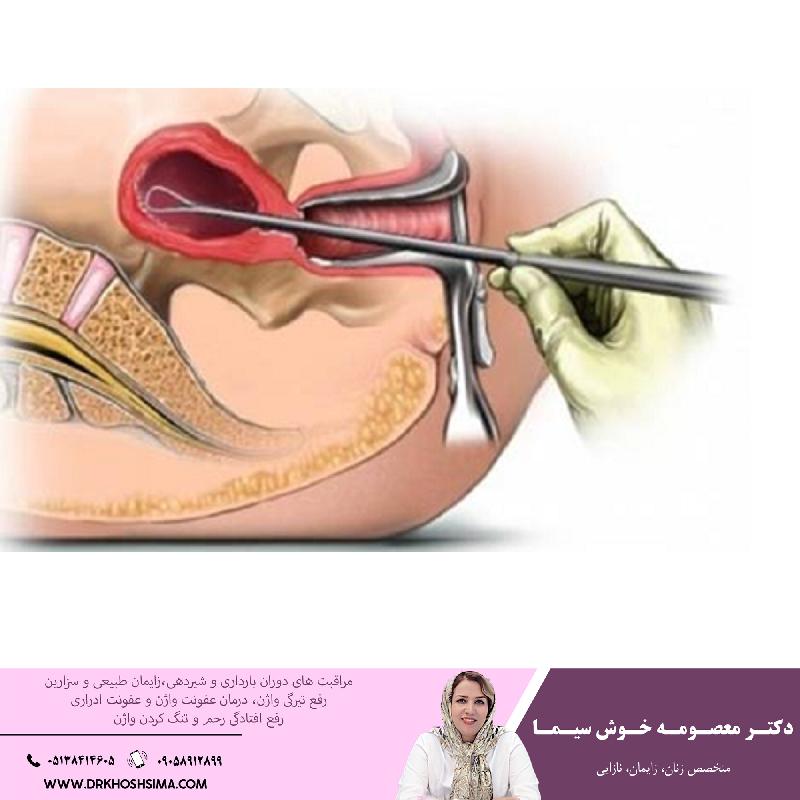 تمام آنچه که بايد در خصوص کورتاژ و مراقبت هاي بعد از آن بايد بدانيد