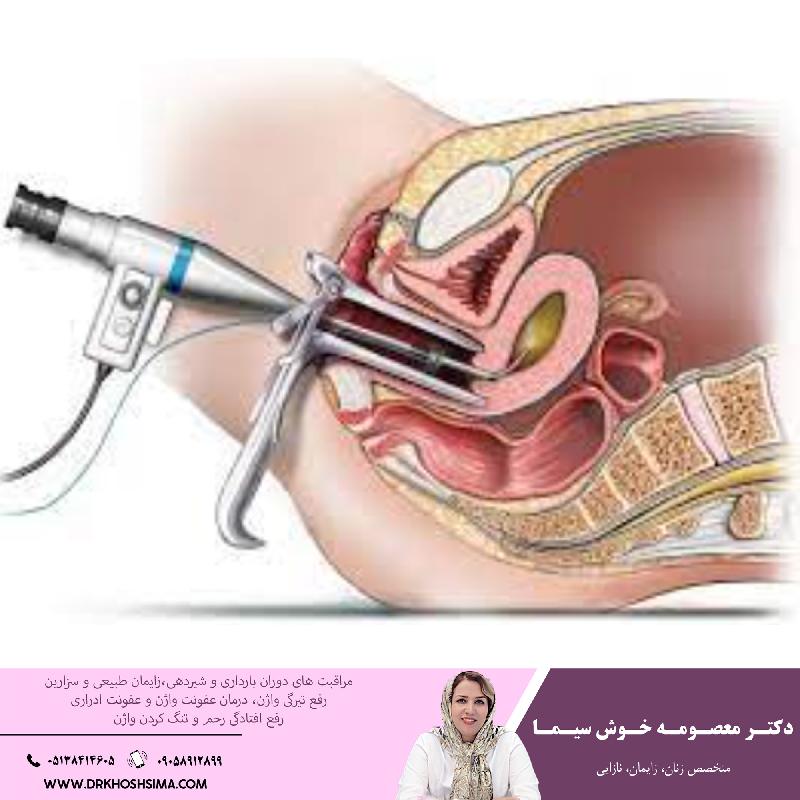 تمام آنچه که بايد در خصوص کورتاژ و مراقبت هاي بعد از آن بايد بدانيد