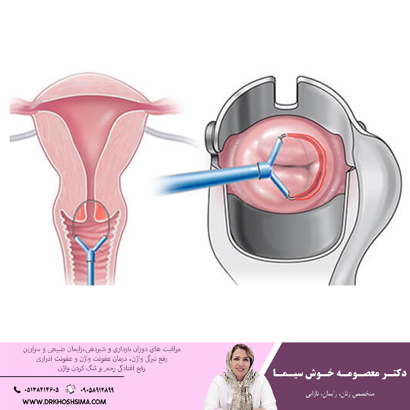 تمام آنچه که بايد درباره سرطان واژن بدانيد