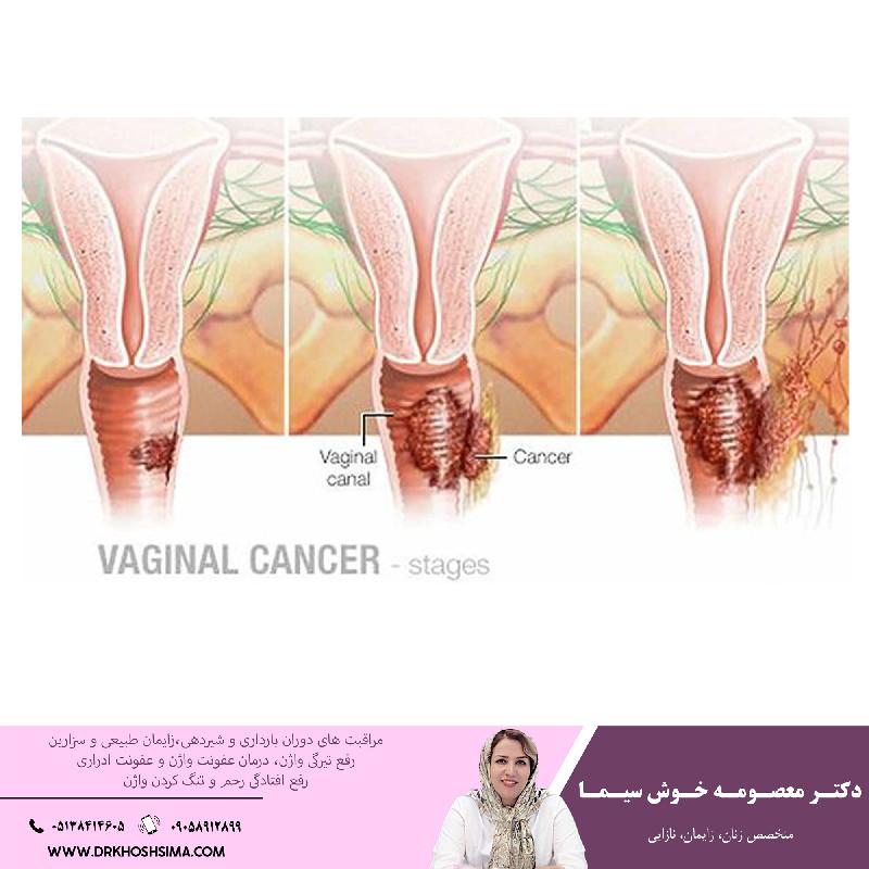 تمام آنچه که بايد درباره سرطان واژن بدانيد