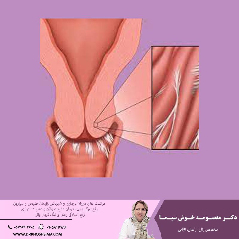 چسبندگي رحم چيست و علت و روش هاي درمان آن